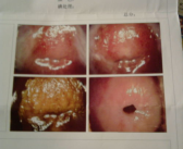 宫颈糜烂影响怀孕吗,宫颈糜烂对怀孕的影响解析